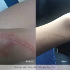 RejuvaSil Silicone Scar Gel -Glow Up Beauty Store GUEST 097ac1ff c358 49fe a05d ea15c566ab77