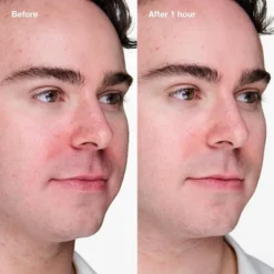 Clinique Acne Solutions Clinical Advanced Clearing Gel - 0.34 Fl Oz - Ulta Beauty -Glow Up Beauty Store GUEST 2a6383bd 53d4 47f5 afa6 36300b83c5e6