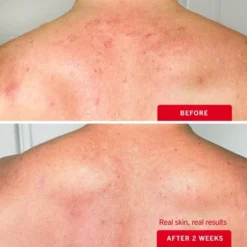 FIRST AID BEAUTY Body Acne Clearing Mist With 2% Salicylic Acid - 3oz - Ulta Beauty 14 FIRST AID BEAUTY Body Acne Clearing Mist With 2% Salicylic Acid - 3oz - Ulta Beauty -Glow Up Beauty Store GUEST 530f90f0 664c 47cb b394 cbd364ecb840