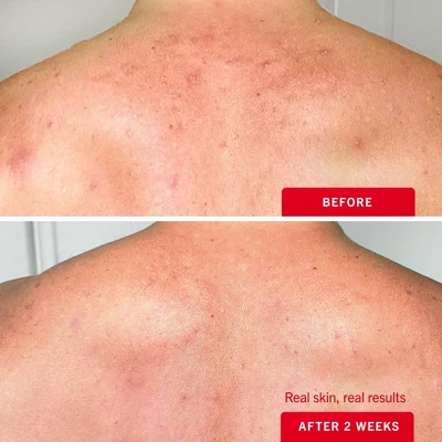 FIRST AID BEAUTY Body Acne Clearing Mist With 2% Salicylic Acid - 3oz - Ulta Beauty 5 FIRST AID BEAUTY Body Acne Clearing Mist With 2% Salicylic Acid - 3oz - Ulta Beauty - Image 3