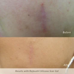 RejuvaSil Silicone Scar Gel -Glow Up Beauty Store GUEST 72fc7fc6 5245 45c3 9df5 e9af54d13252