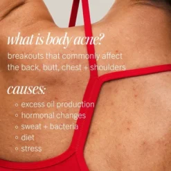 FIRST AID BEAUTY Body Acne Clearing Mist With 2% Salicylic Acid - 3oz - Ulta Beauty 20 FIRST AID BEAUTY Body Acne Clearing Mist With 2% Salicylic Acid - 3oz - Ulta Beauty -Glow Up Beauty Store GUEST 934bce76 001f 4879 afe6 bdef6db8b601