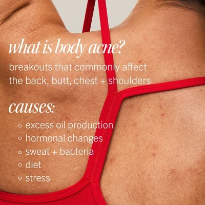 FIRST AID BEAUTY Body Acne Clearing Mist With 2% Salicylic Acid - 3oz - Ulta Beauty 11 FIRST AID BEAUTY Body Acne Clearing Mist With 2% Salicylic Acid - 3oz - Ulta Beauty - Image 9