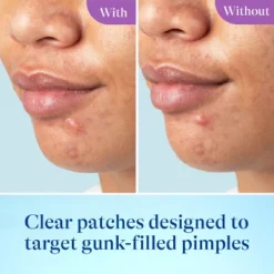 Differin Skin Restore Power Patches - 23ct -Glow Up Beauty Store GUEST aec136e0 053a 4494 8e06 dc714b3ebcd8